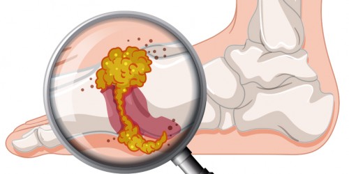 What You Should Know About Metabolic Arthritis (Gout): Symptoms, Diagnosis, Treatment